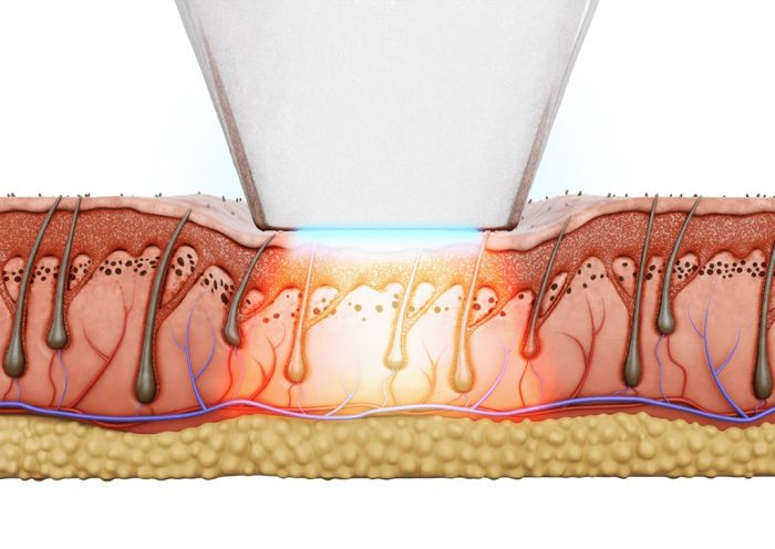 Laser Hair Removal 11801