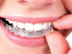 Las Vegas Invisalign