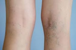 Vein Treatment Long Island | Vein Removal LI | Vein Treatments Near Me