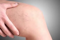 Vein Treatment NYC | Vein Removal NYC | Varicose Vein Treatment NYC