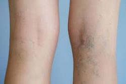 Harvard Trained Vein Doctor | 7 Qualities of the Best Varicose Vein Doctor Near Hackensack