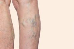 Harvard Trained Vein Doctor | The Best Varicose Vein Treatment in Paramus