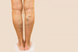 Harvard Trained Vein Doctor | What Can I Expect from Varicose Vein Treatment in Clifton?