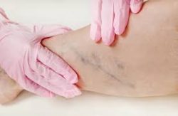 When to see a Vascular Doctor? | Vein Treatment NJ