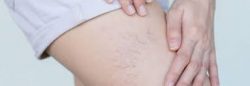 Spider Veins Treatment New York | Spider Vein Doctors NYC