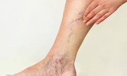 Sclerotherapy | Long Island Vein Treatment