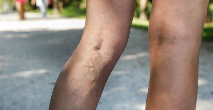 Venaseal Treatment | Vein Treatment San Diego