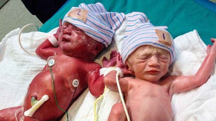 Top Guide: When Do You Find Out the Gender of Twins