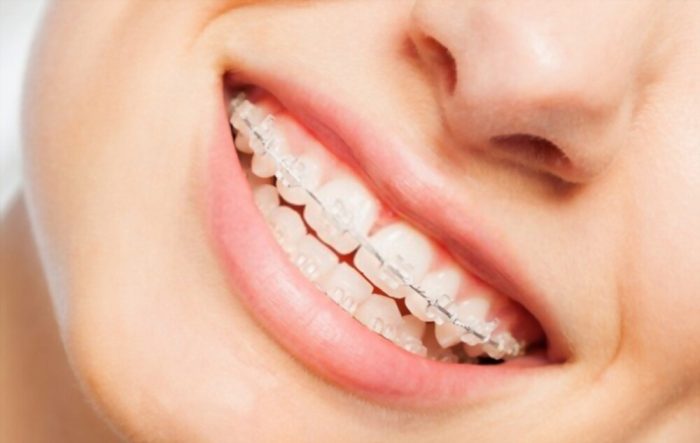 Cost of Invisalign Braces For Adults | Invisalign Cost Vs. Braces Cost