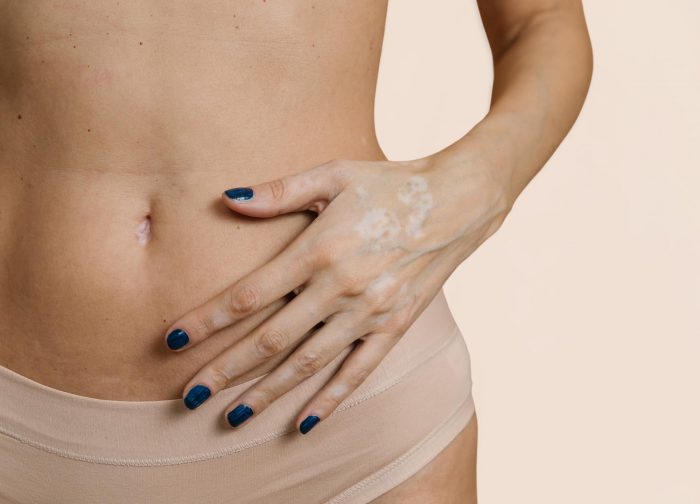 What Is Involved in Tummy Tuck Surgery?