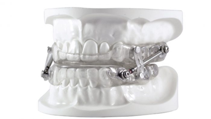 Oral Appliance For Sleep Apnea