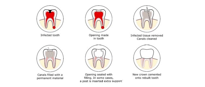 Expert Root Canal Treatment at Wellness Dental Studio