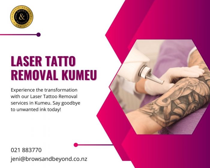 Say Goodbye to Unwanted Tattoos with Laser Tattoo Removal in Kumeu