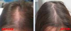 Best Mesotherapy For Hair Loss Treatment