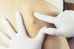 What’s the Cost of Sebaceous Cyst Removal?