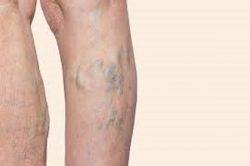 blue light therapy for varicose veins