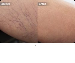 Spider Veins Look Worse After Treatment