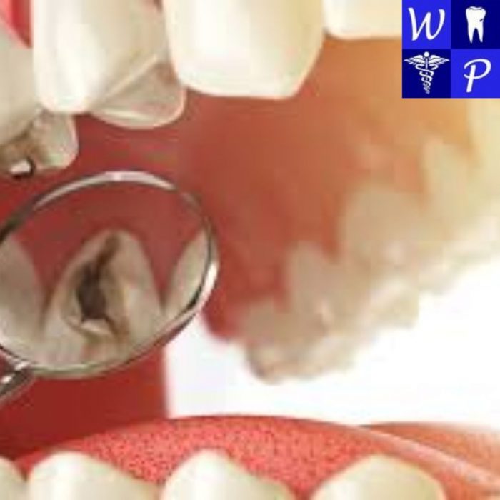 Efficient Tooth Extractions at West Plano Dental