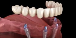 The Process of Getting Full Mouth Implants in Houston