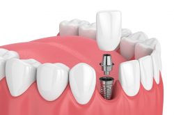 The Process Of Getting All On X Implants | Edge Dental