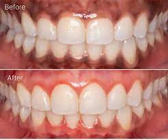 The Benefits of Laser Gum Bleaching in Houston