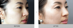 Professional Nose Surgery in Korea