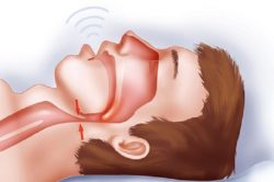 Effective Sleep Apnea Therapies in Houston, TX