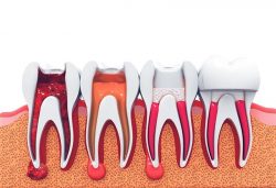 Expert Root Canals in Plano for Pain Relief