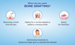 When Is Bone Grafting Necessary? Key Signs and Solutions