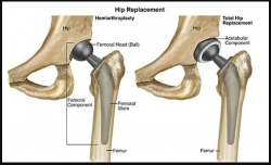 Hip Replacement Surgery cost in India | HOSPIDIO