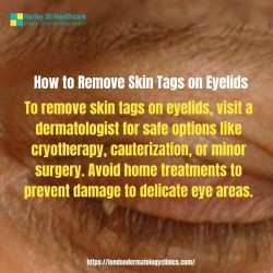 How to Remove Skin Tags on Eyelids