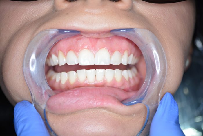 Why You Should Consider Advanced Laser Gum Bleaching