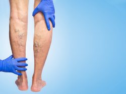 Varicose Veins: Causes, Symptoms & Treatments Explained