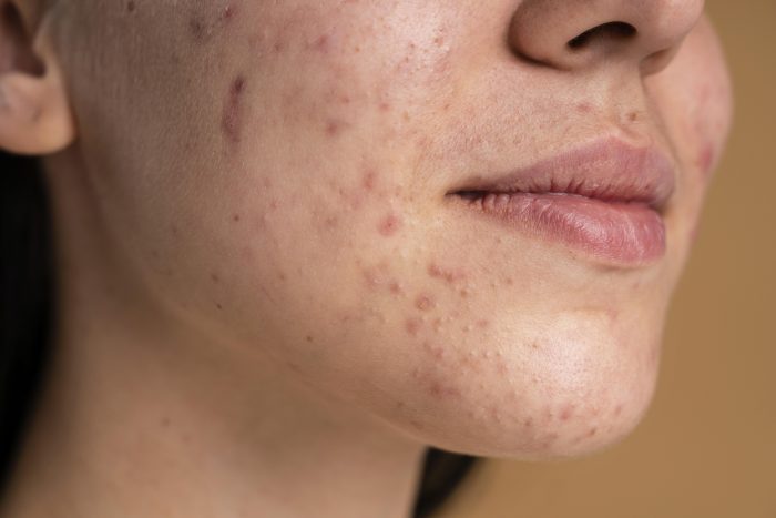 Acne Scar Treatment in Singapore – The Ogee Clinic