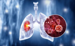 Lung Cancer Treatment in India: Cost Starting from $5500 | HOSPIDIO