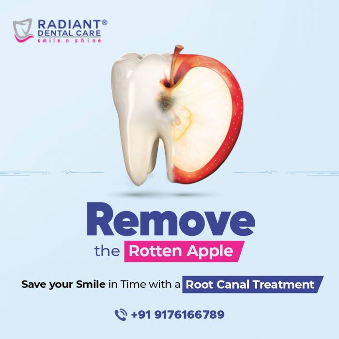 Save Your Smile with Root Canal Treatment