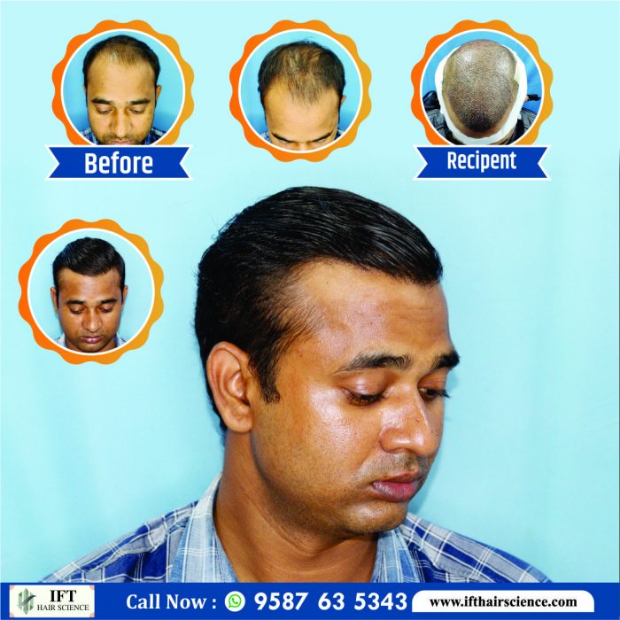 Best hair transplant clinic in Kota
