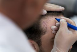 Scalp Micropigmentation in Dubai | Eden Aesthetics Clinic