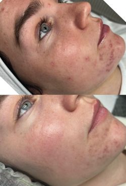 What is SQT Microneedling in London