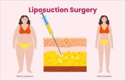 Expert Liposuction Services | Expertise by Dr Tremp