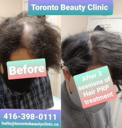 Revitalize Your Hair with Carboxy Therapy for Fast and Visible Growth