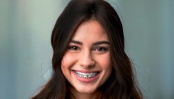Teeth Braces: Get the Perfect Smile