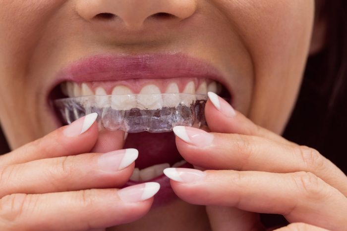 Transform Your Smile with Invisalign in Sydney