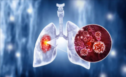 Affordable Lung Cancer Treatment Cost in India with Quality Care | HOSPIDIO