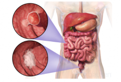 Colorectal Cancer: Know the Signs Before It’s Too Late