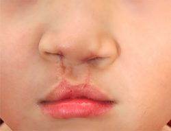 Cleft Lip and Palate Surgery: What You Need to Know