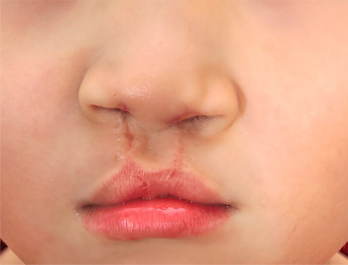 Cleft Lip and Palate Surgery: What You Need to Know