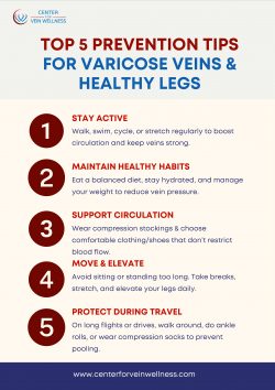 Top 5 Prevention Tips for Varicose Veins & Healthy Legs