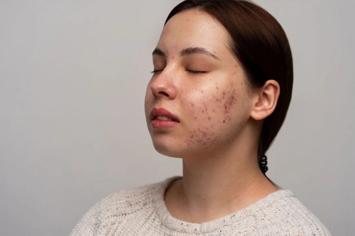 Melasma Care That Works For Real Results