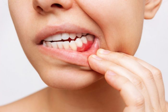 Who Is a Good Candidate for All-on-X Implants?